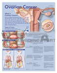 Understanding Ovarian Cancer Anatomical Chart